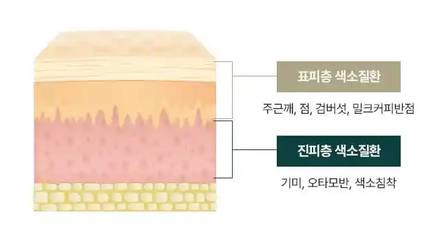 피부 손상 최소화 색소치료
