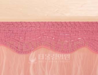STEP 04. 분해된 색소 림프 배출