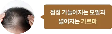 점점 가늘어지는 모발과 넓어지는 가르마